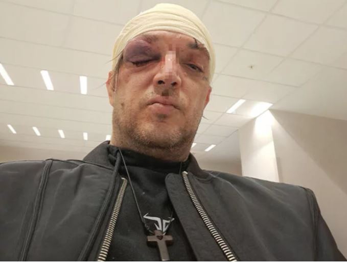Zoran Marjanović pretučen: Prva fotografija nakon napada